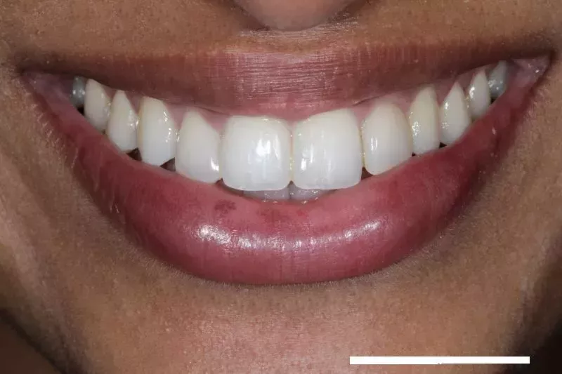 After Invisalign treatment