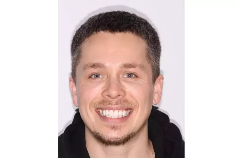 Before bonding and invisalign