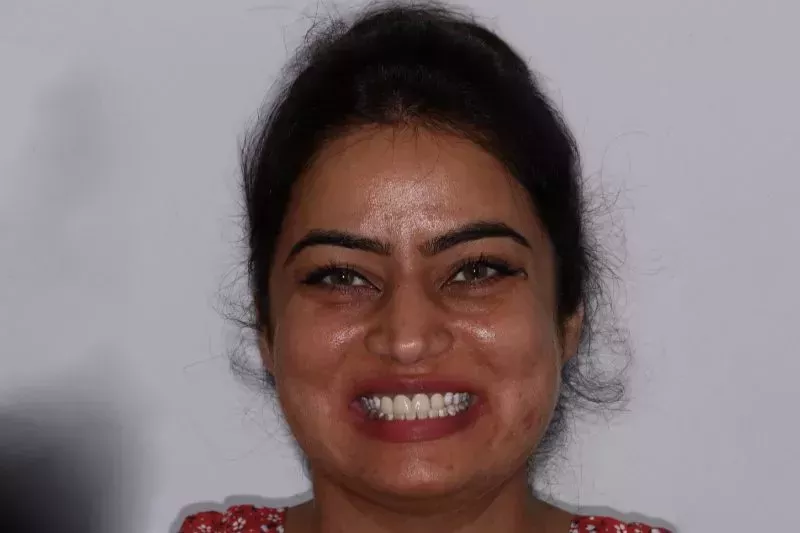 Before dental veneers