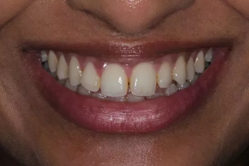 After Invisalign treatment