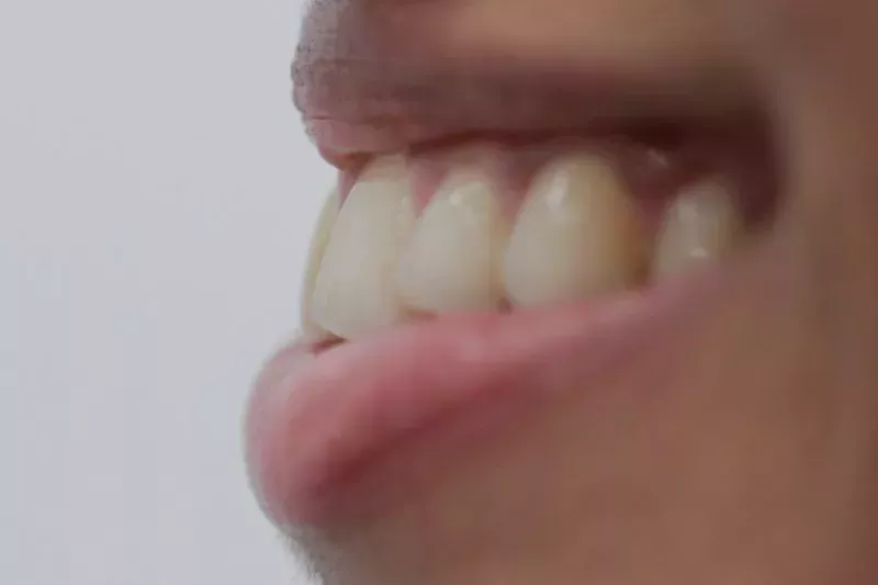 After Invisalign treatment