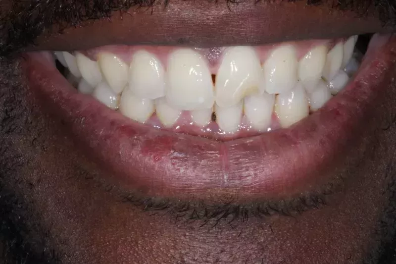 Chipped tooth before bonding