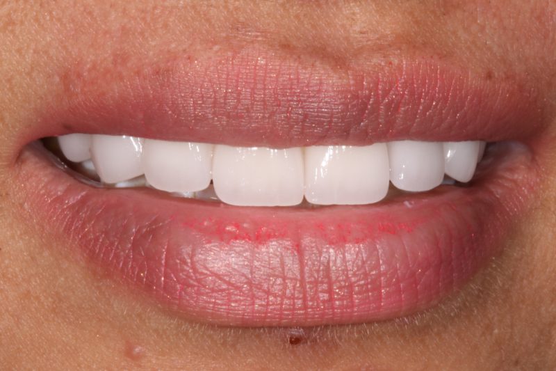 Close up of no damage veneers