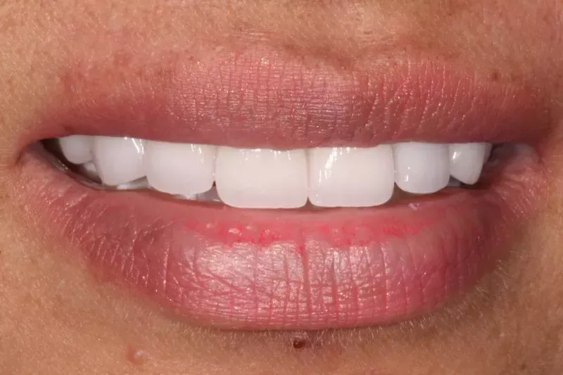 Close up of no damage veneers