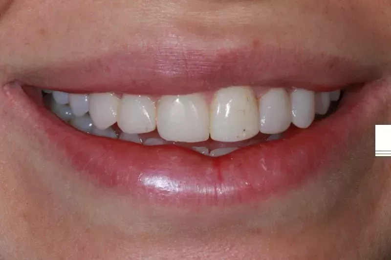 Composite bonding veneers before
