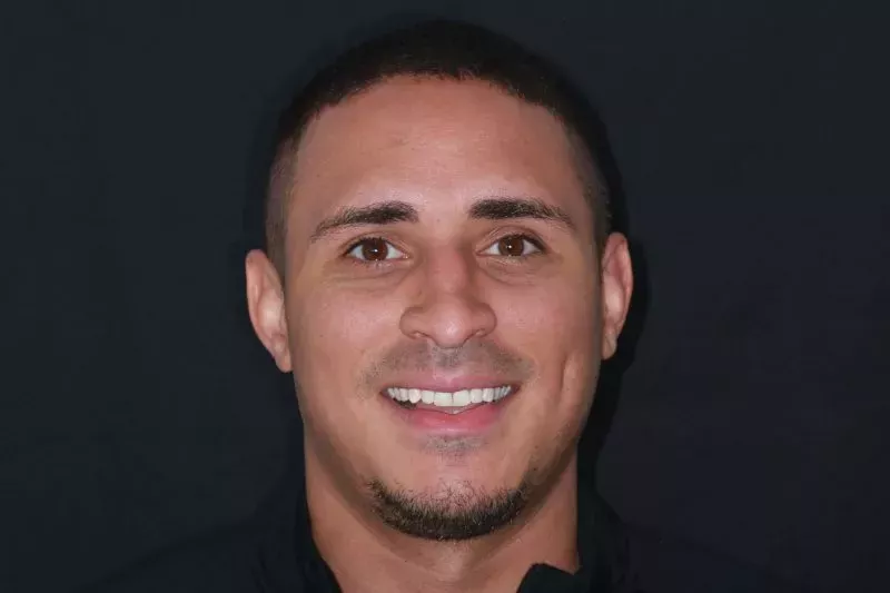 Fixing stained teeth with composite bonding