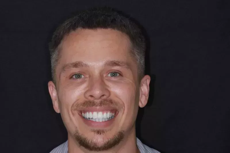 Invisalign and composite