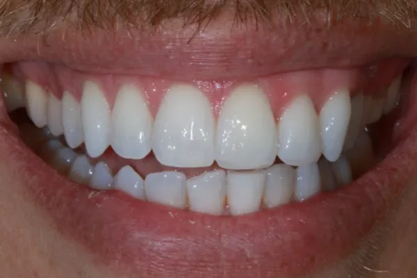 Invisalign TKC Dental