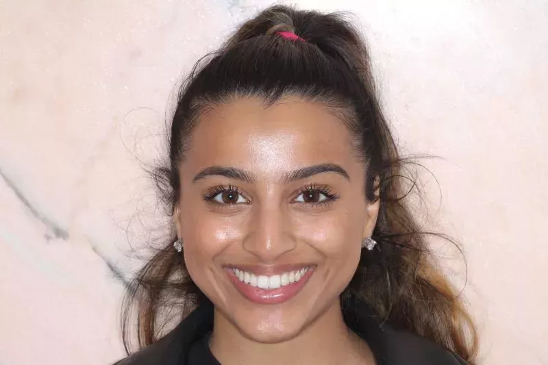 After Invisalign treatment