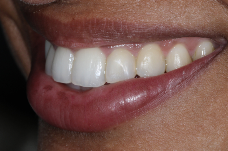 After Invisalign treatment