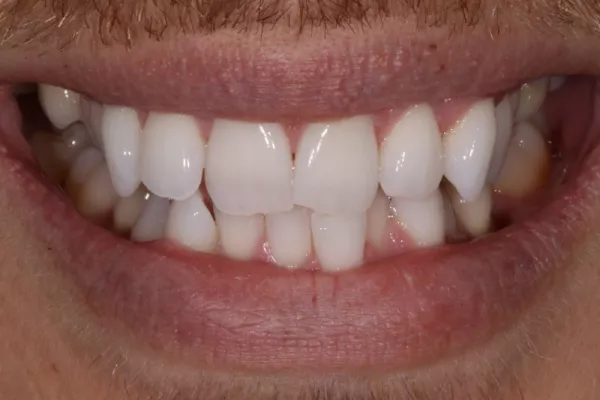 Invisalign TKC Dentist 