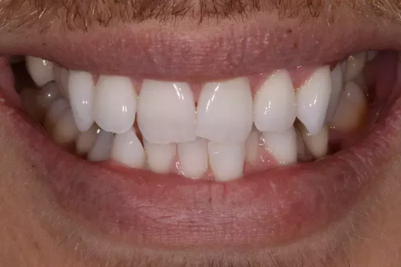 before invisalign and bonding