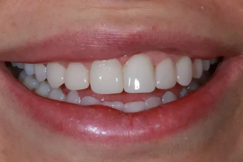 composite bonding veneers after