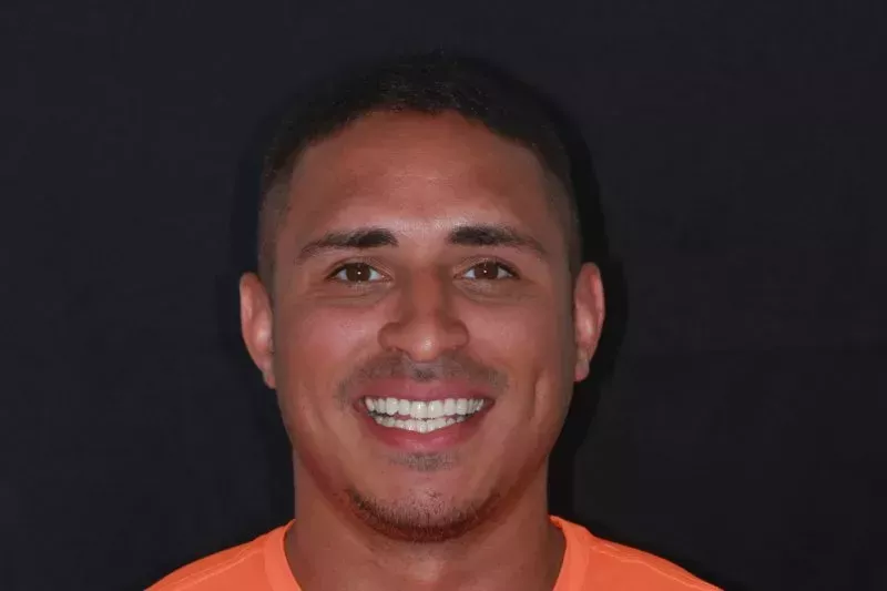 discolouration fixed with composite bonding