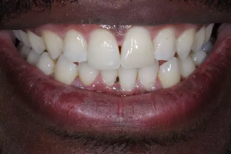 fixing a chipped tooth with composite bonding