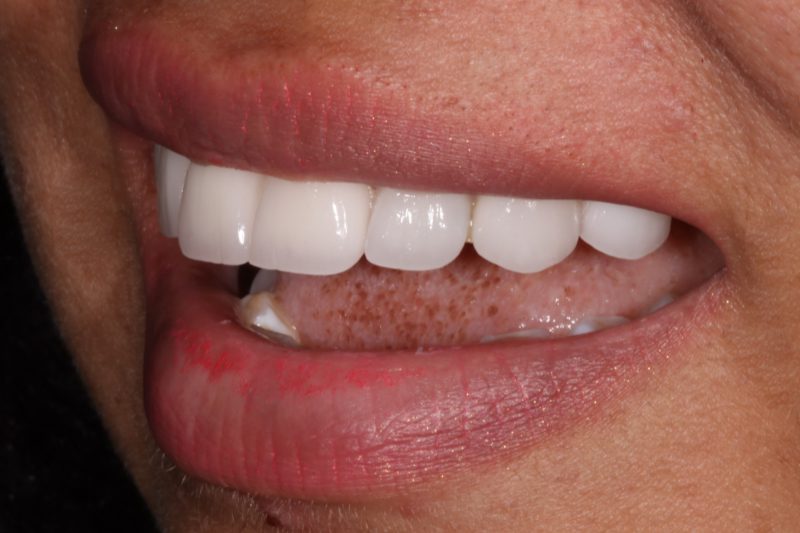 new dental veneers no damage
