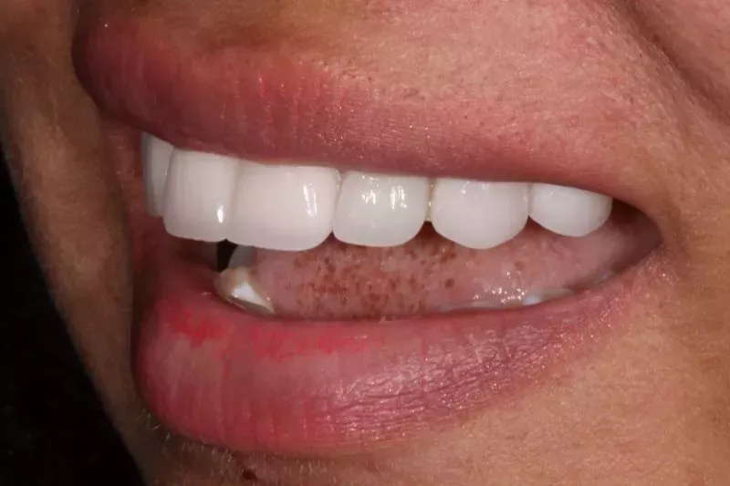 new dental veneers no damage