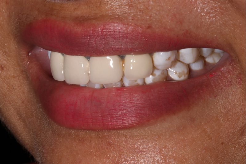 replacing old crowns and veneers