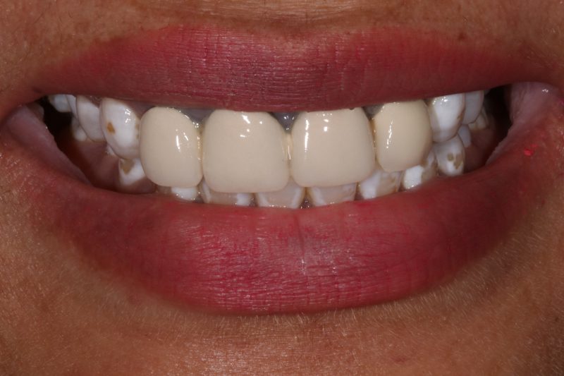 replacing old veneers and crowns