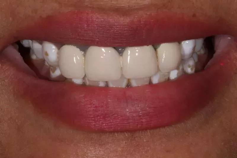 replacing old veneers and crowns