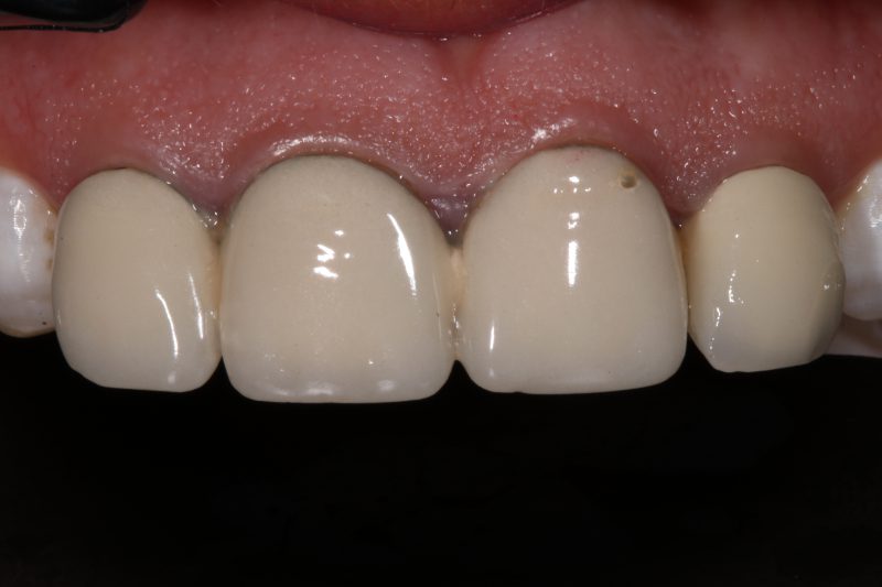 replacing worn down crowns