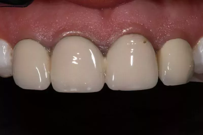 replacing worn down crowns
