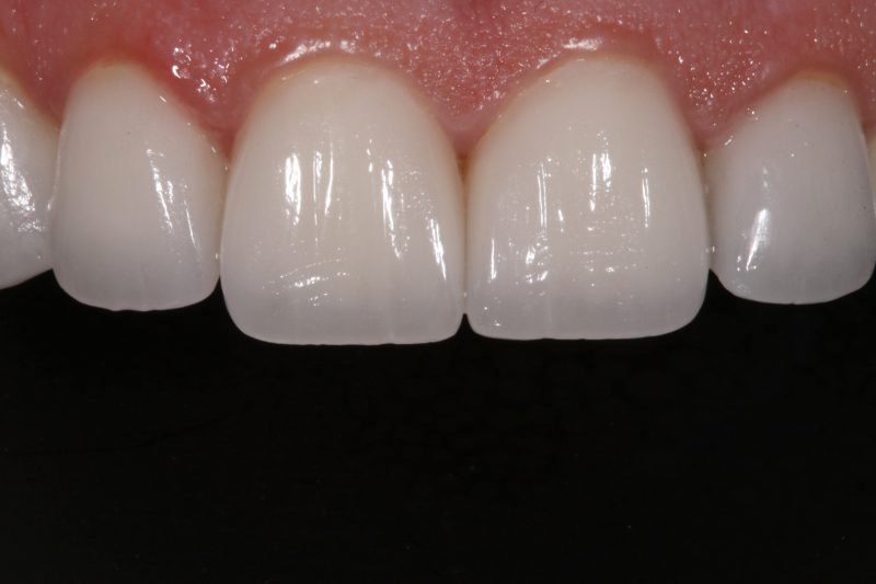 ultra thin and natural veneers