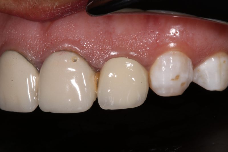 worn down crowns close up