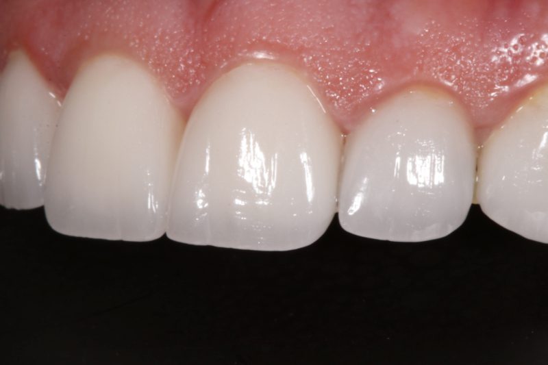 zero damage veneers by dr sheraz aleem