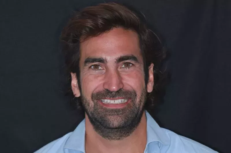 Before Porcelain Veneers