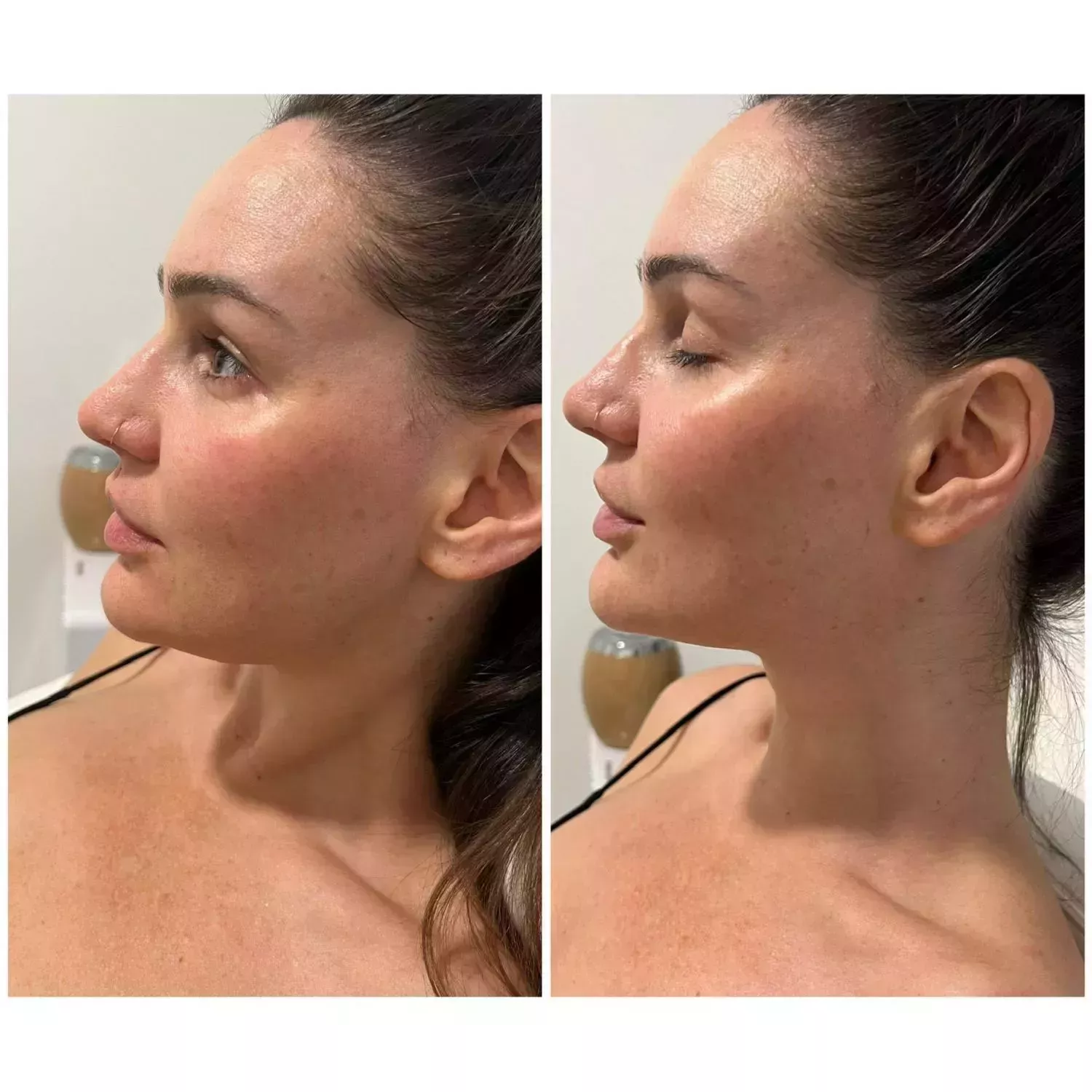 Chin Filler Knightsbridge Kensington Central London