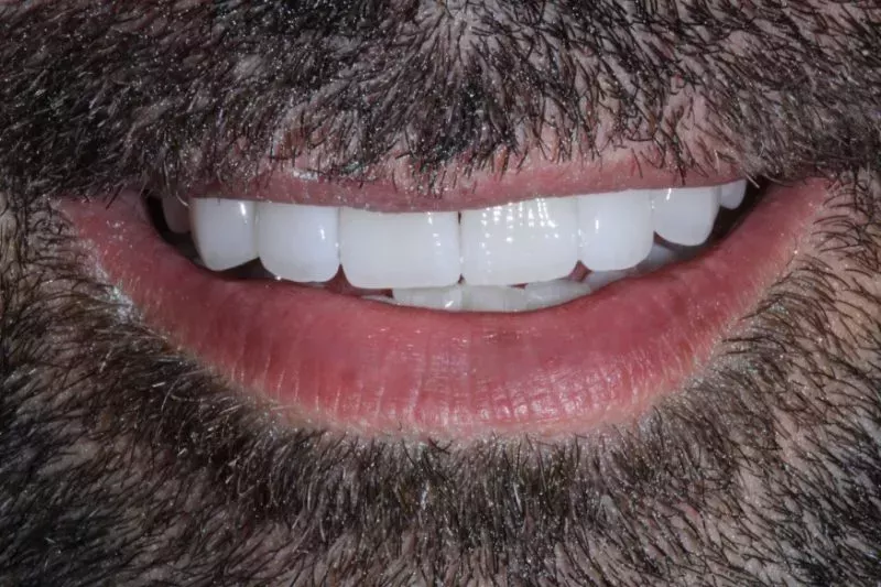 after non cutting veneers