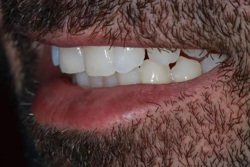 Before Porcelain Veneers