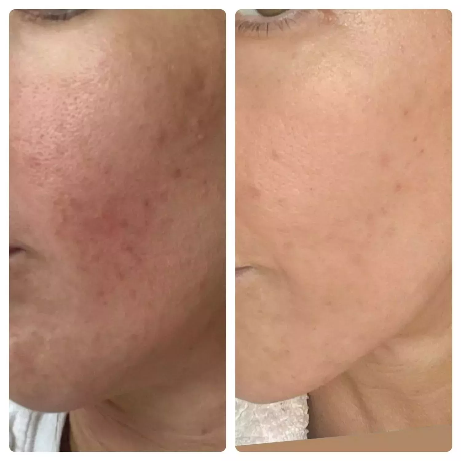 Acne scarring biomicroneedling Knightsbridge Kensington Central London
