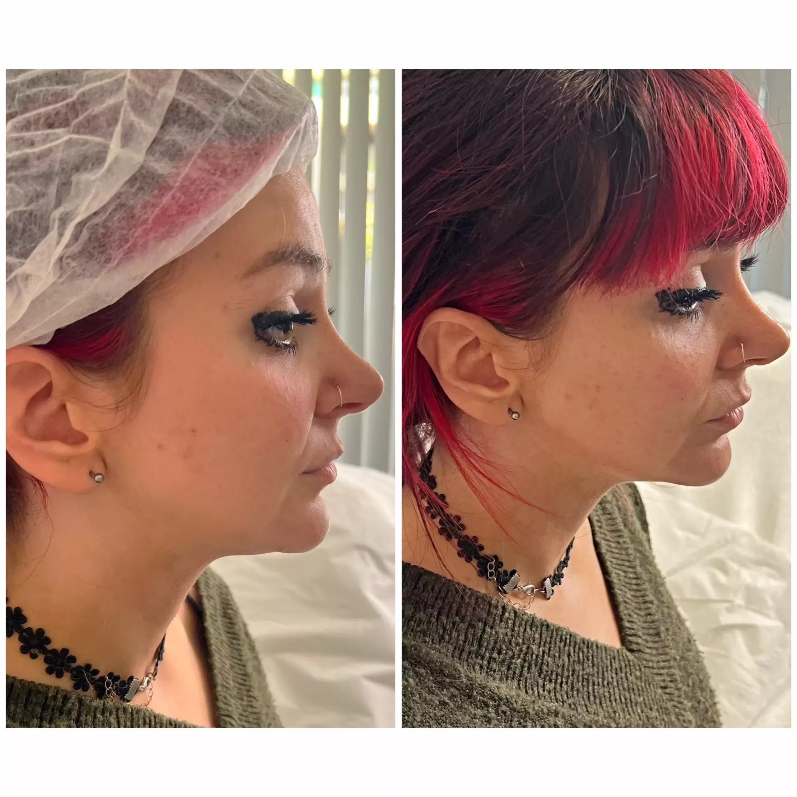 Jawline definition Knightsbridge Kensington Central London