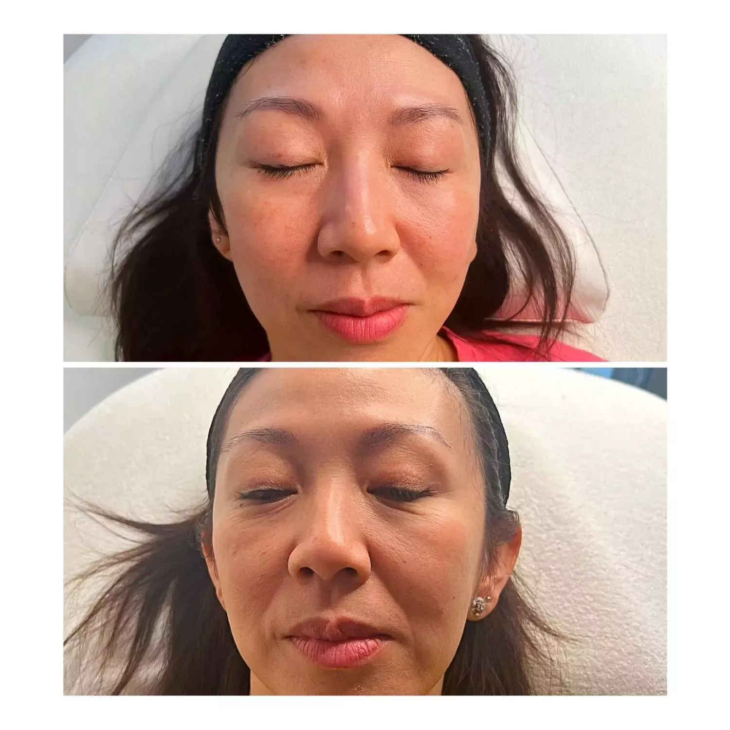 RF Microneedling Knightsbridge Kensington Central London