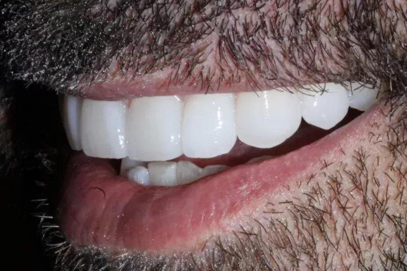 after non cutting veneers