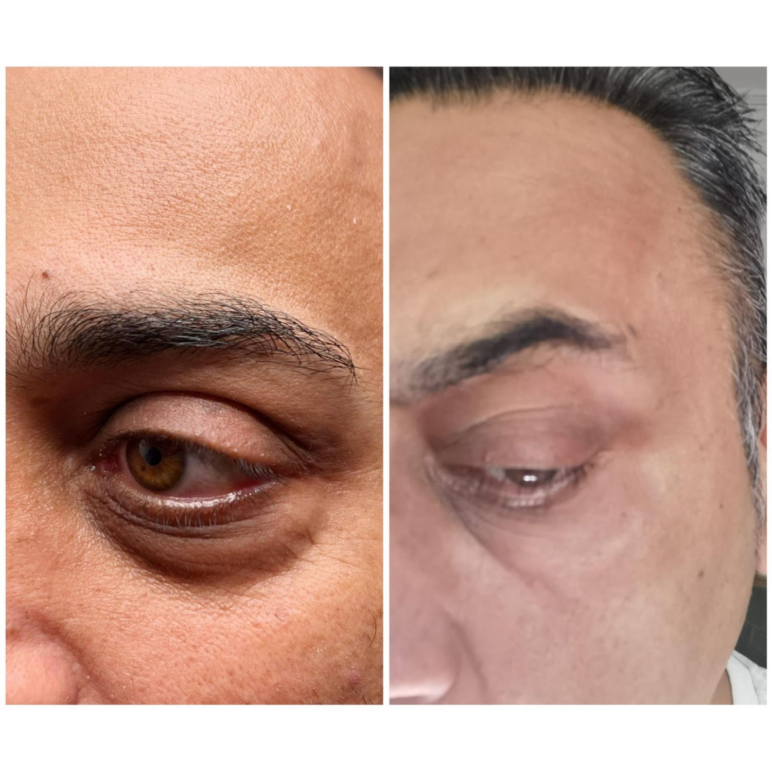 Derma eye Mesotherapy for under eye Knightsbridge Kensington Central London
