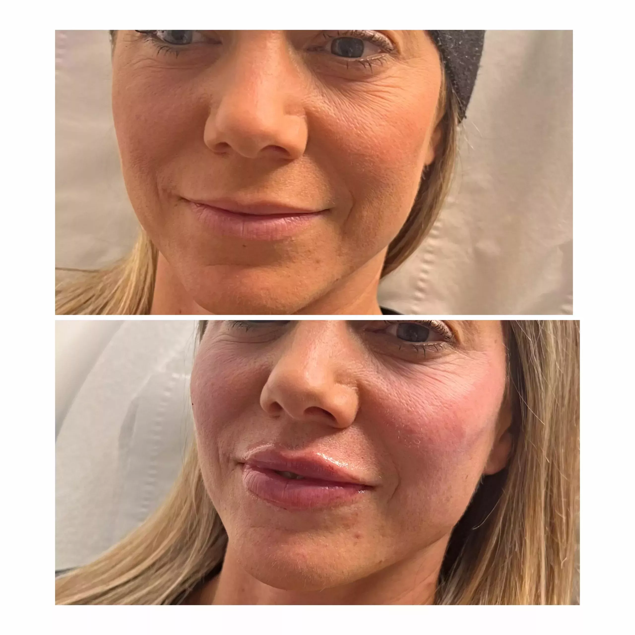 Cheek and lip enhancement Knightsbridge Kensington Central London