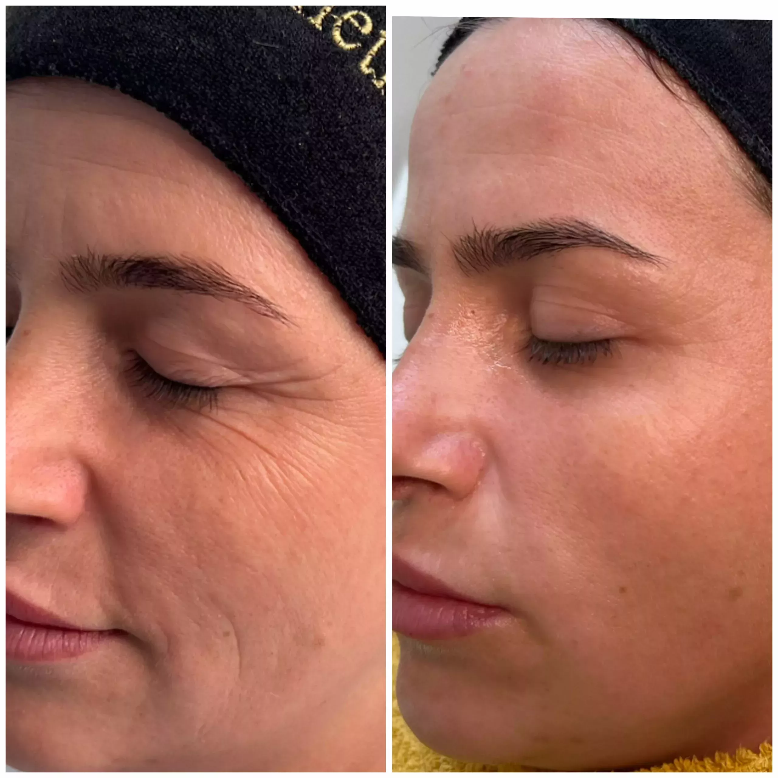 RF Microneedling, Anti-wrinkle Knightsbridge Kensington Central London