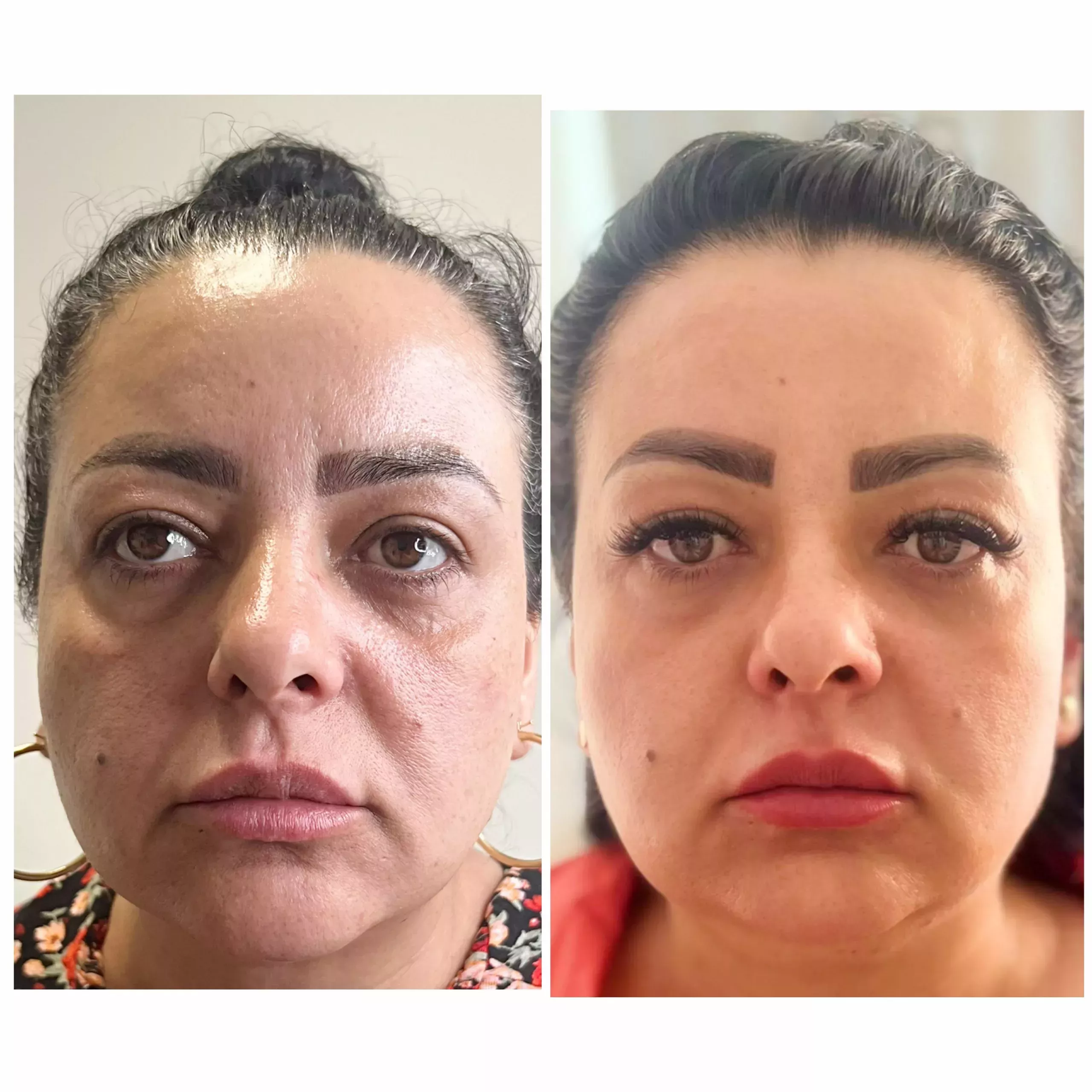 Cheek filler Hifu Knightsbridge Kensington Central London