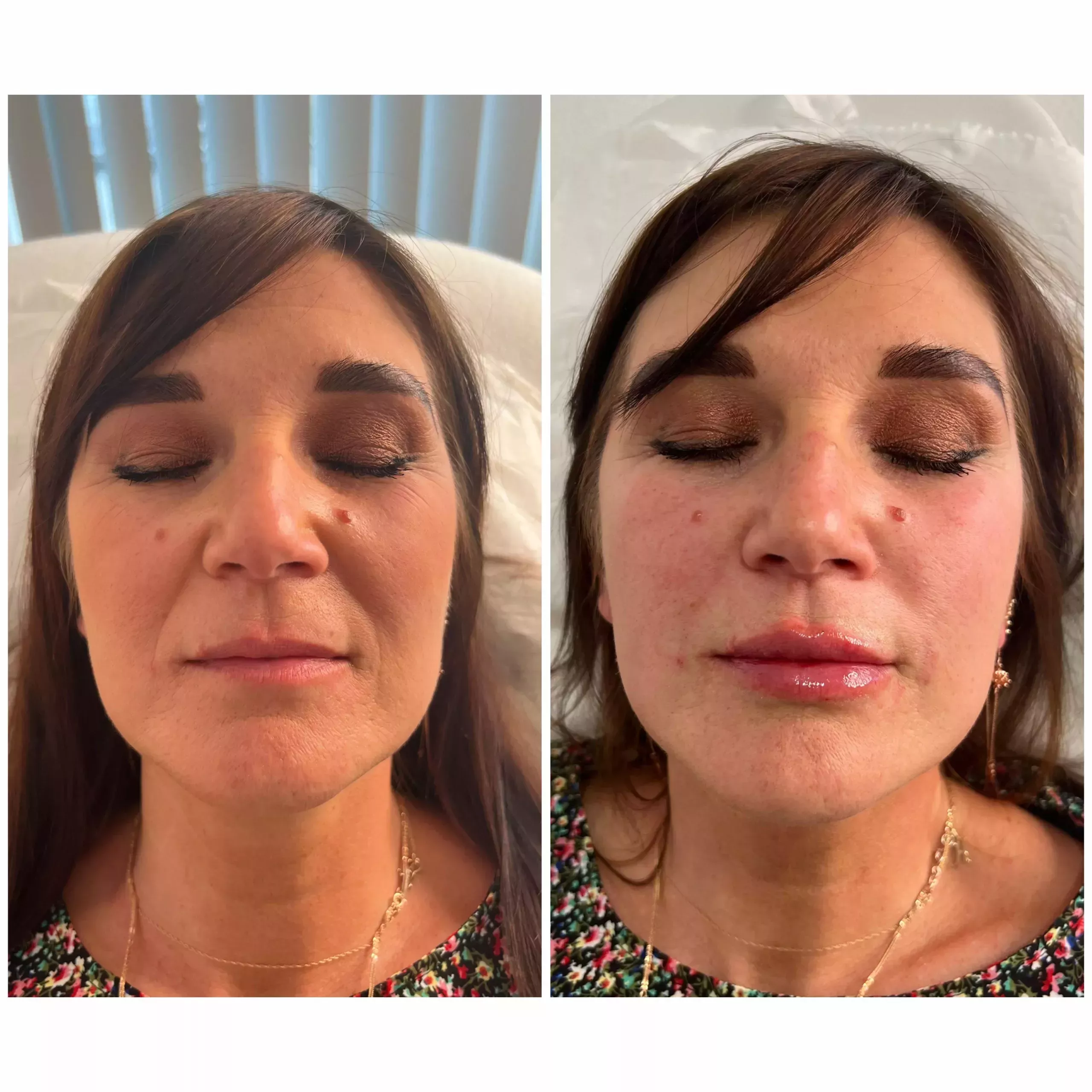 Nasobial folds and lip filler Knightsbridge Kensington Central London