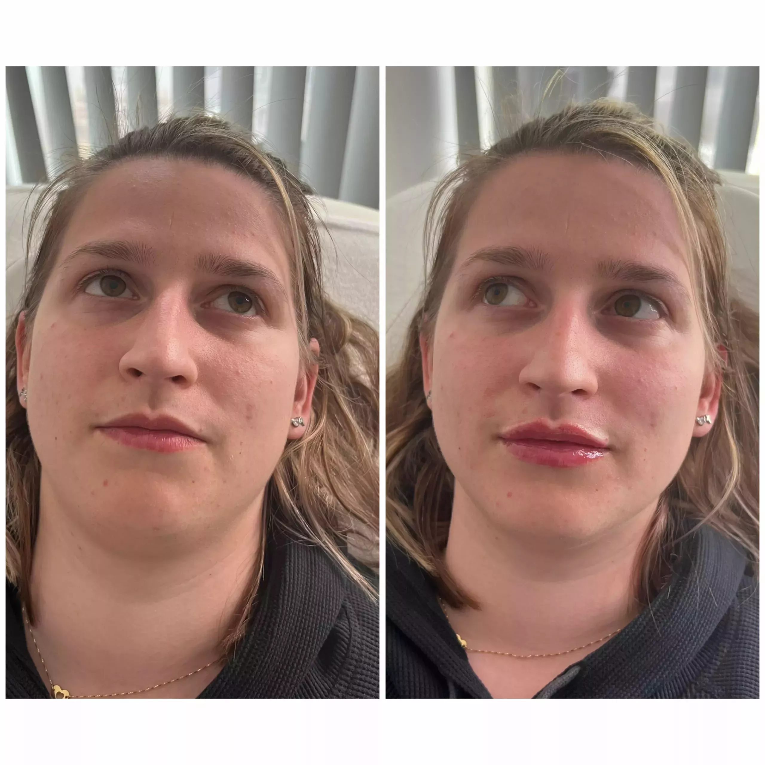 Lip filler Knightsbridge Kensington Central London