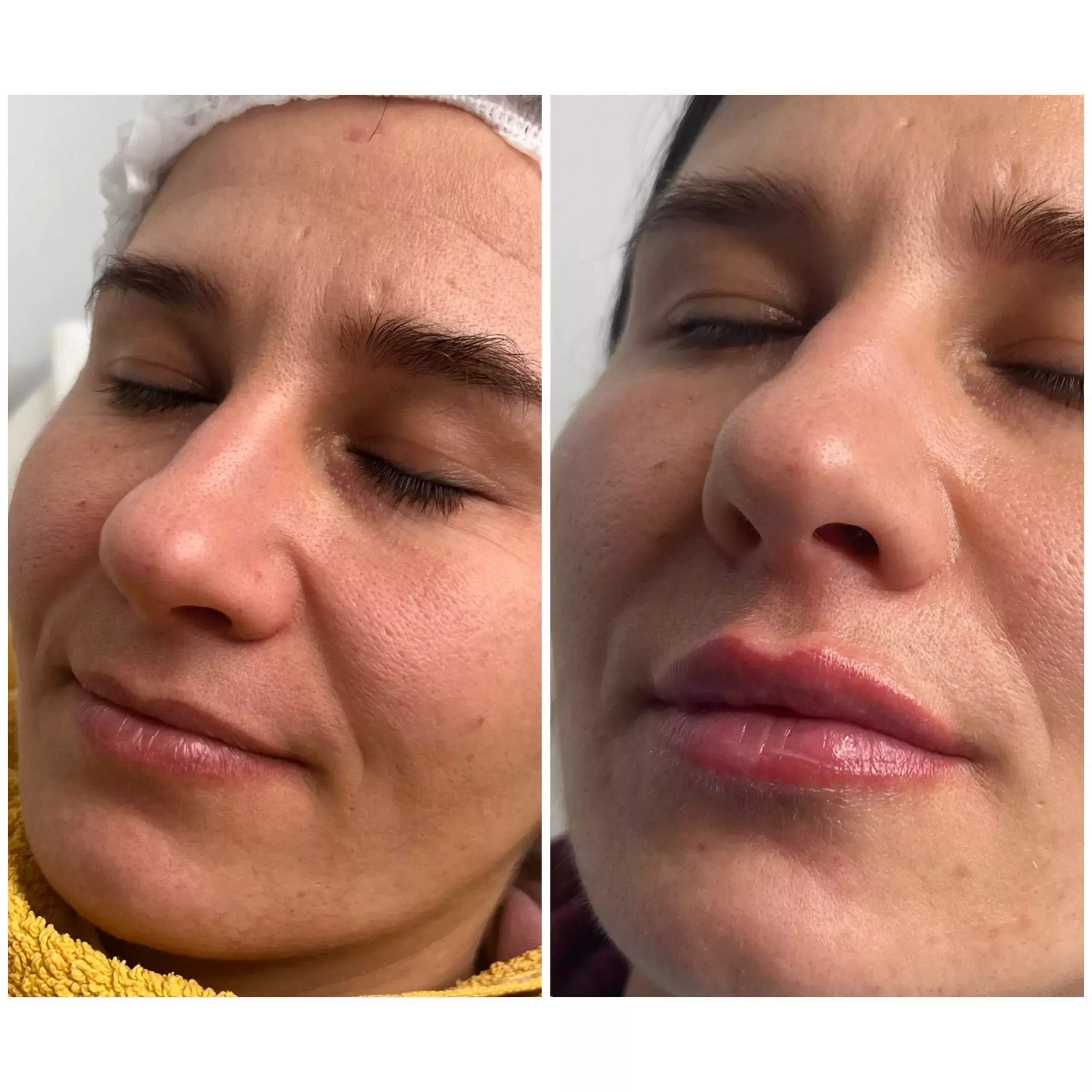 Lip enhancement Knightsbridge Kensington Central London