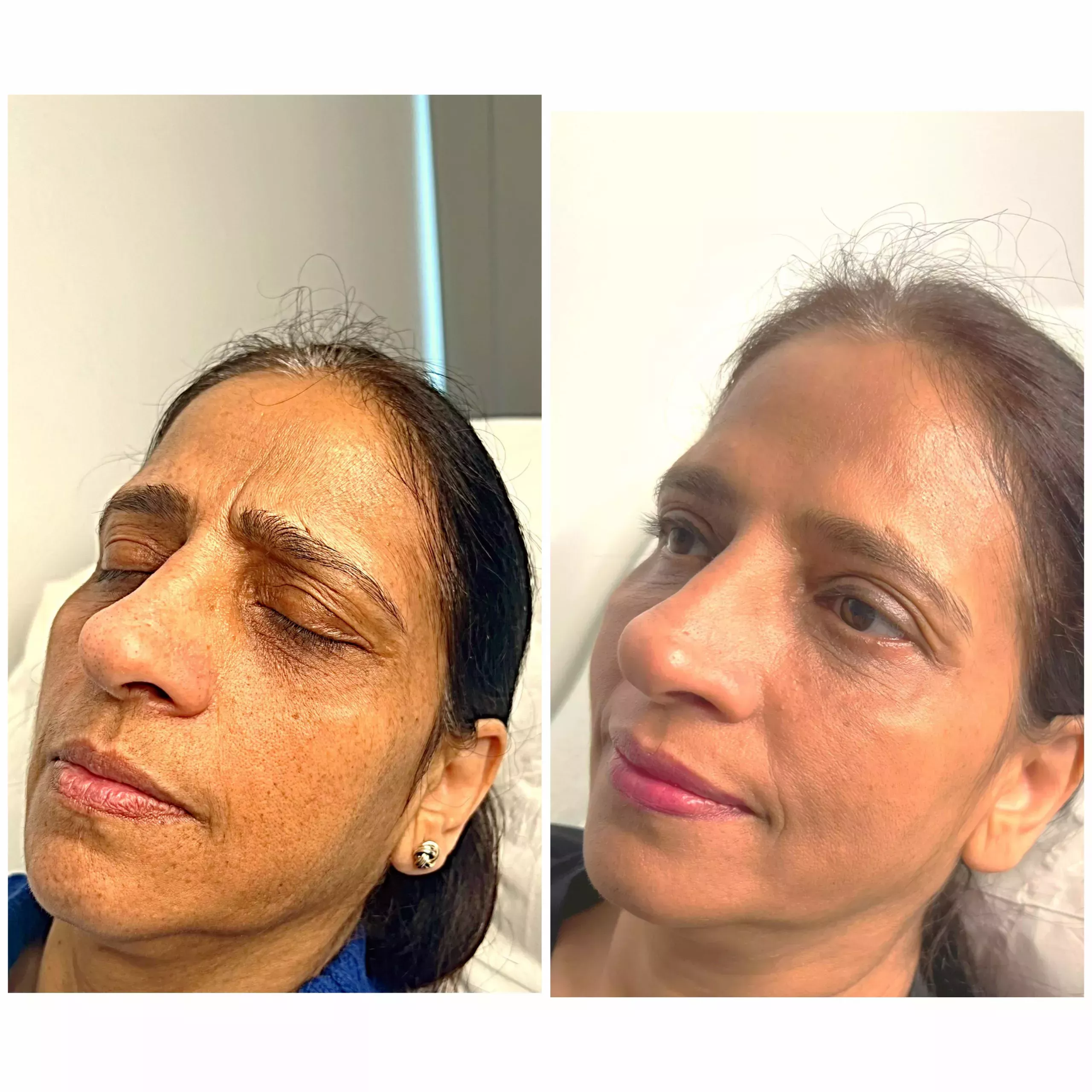 Anti-wrinkle injections, Tear Trough Cheek Filler Knightsbridge Kensington Central London