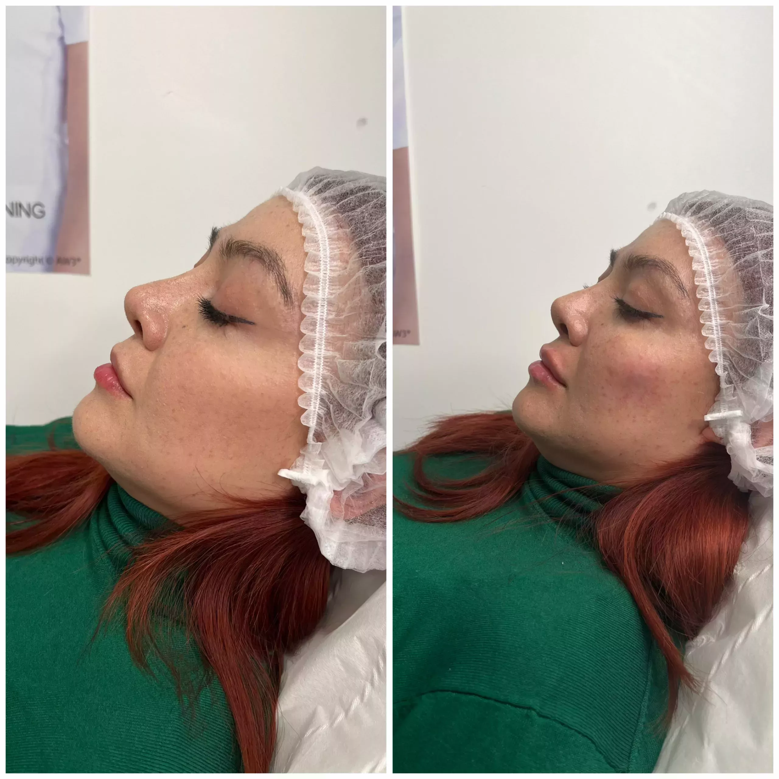 Cheek enhancement Knightsbridge Kensington Central London