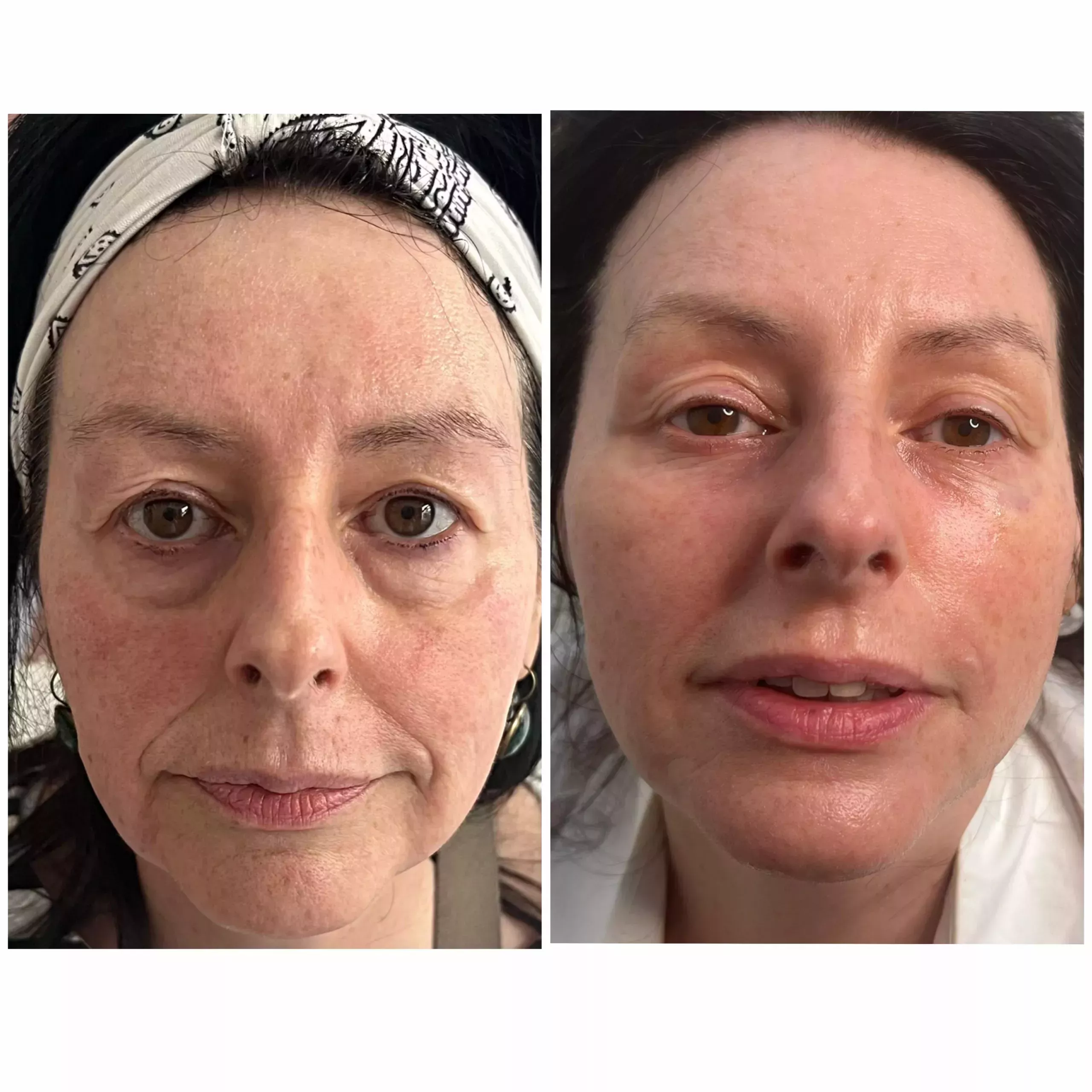 Mesotherapy Knightsbridge Kensington Central London