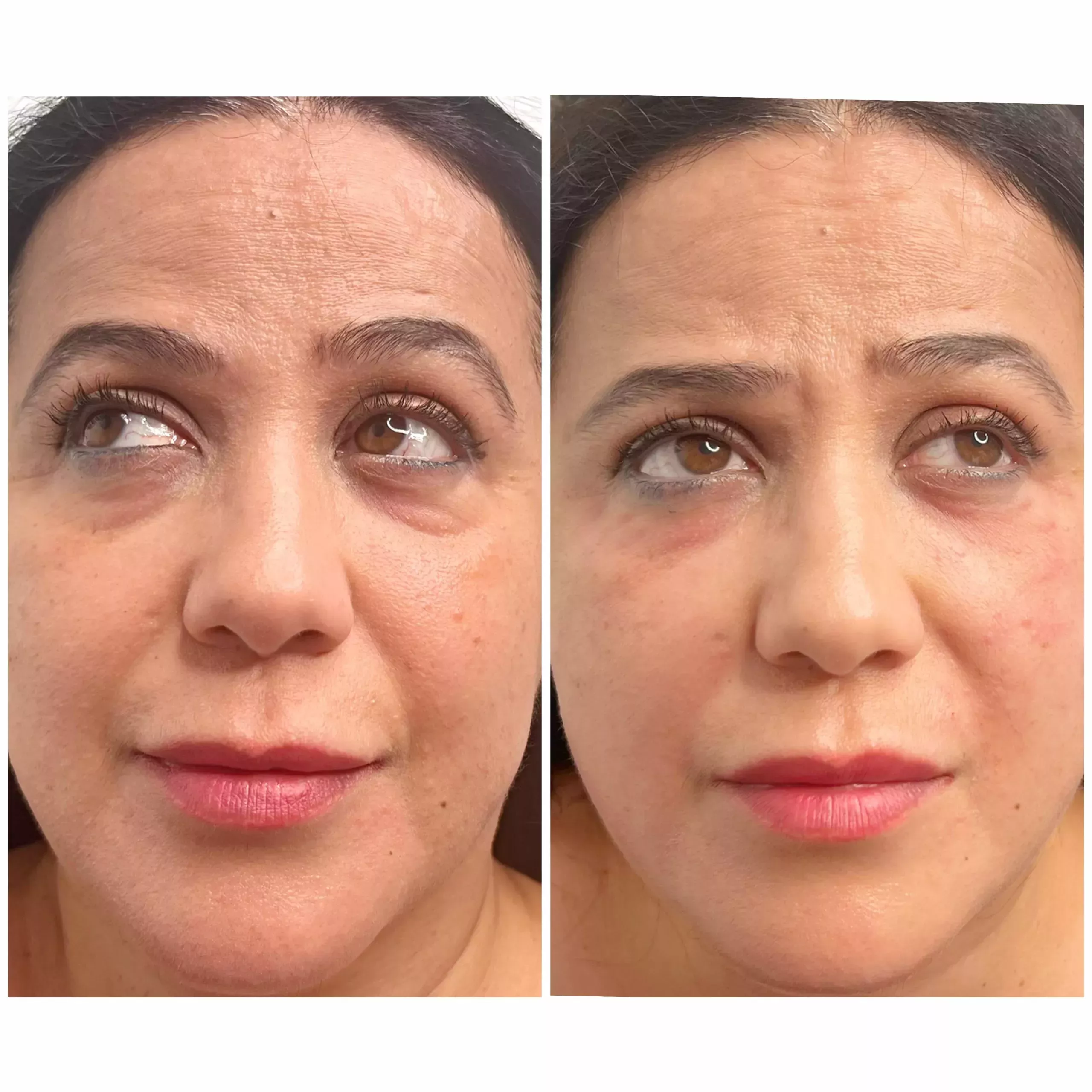 Mesotherapy Knightsbridge Kensington Central London