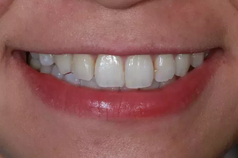Invisalign Results After Invisalign