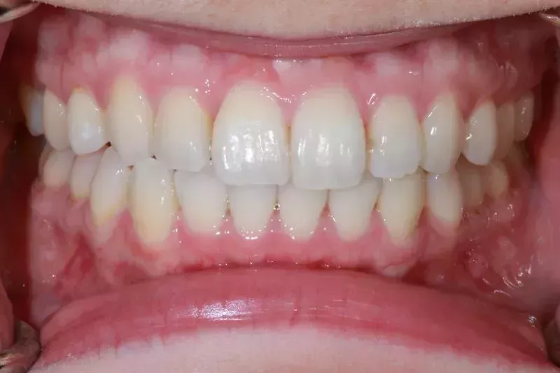 Invisalign Results After Invisalign